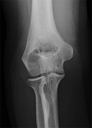 Figure 3: Right elbow anteroposterior radiograph, one year prior to current presentation