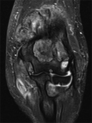 Figure 4: Right elbow coronal T2-weighted fat-suppressed MR image