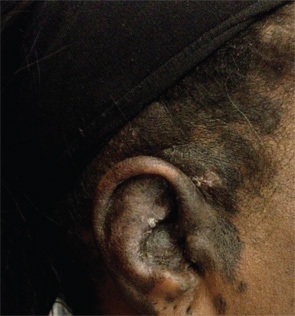 Figures 1a & 1b: Initial rash on ear (1a, below left) and forehead (1b, below right) consistent with discoid lupus erythematous.