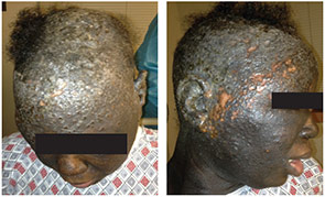 Figure 2: Anterior (a) and lateral (b) views of scalp showing nodular hyperkeratotic lesions with discoloration of involved skin.