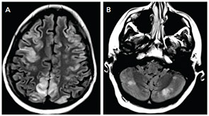 Figure 1: MRI FLAIR images show T2 hyperintensities affecting bilateral parietal and frontal regions (A) and the cerebellum (B).