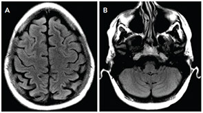 Figure 2: Repeat MRI FLAIR images acquired five weeks later show resolution of previously seen T2 hyperintensities in the parietal and frontal regions (A) and the cerebellum (B).