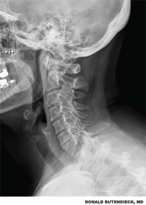 Figure 2: This radiograph of the cervical spine shows multilevel facet degenerative arthrosis with neural foraminal encroachment at several levels.
