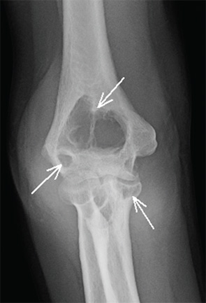 Figure 1: Right elbow anteroposterior radiograph