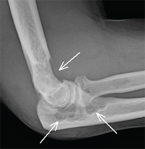 Figure 2: Right elbow lateral radiograph