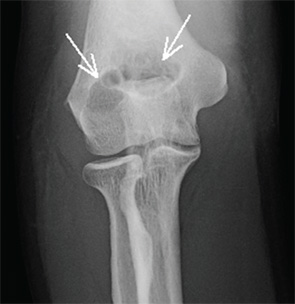 Figure 3: Right elbow anteroposterior radiograph, one year prior to current presentation