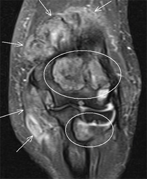 Figure 4: Right elbow coronal T2-weighted fat-suppressed MR image