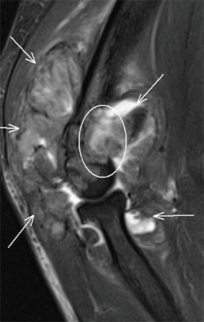 Figure 5: Right elbow sagittal T2-weighted fat-suppressed MR image