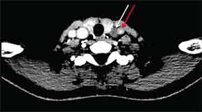 CT angiography of the neck axial view demonstrating complete occlusion of left common carotid artery (white arrow) and significant wall thickening of the left subclavian artery (red arrow)