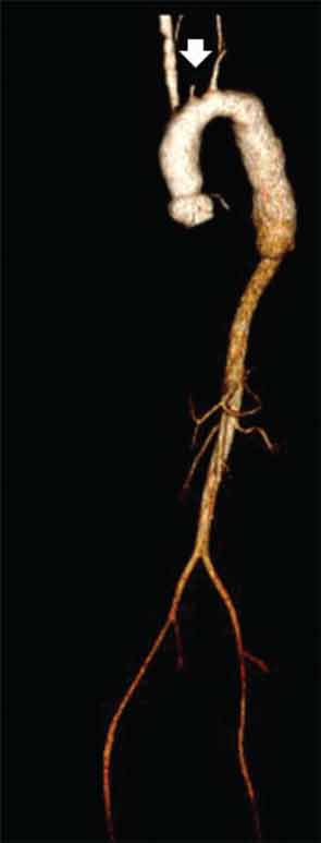 CT angiogram of chest, abdomen and pelvis