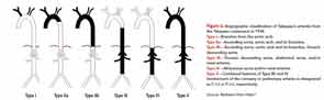 Angiographic classification of Takayasu’s arteritis