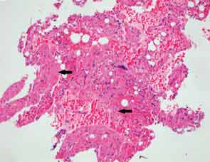 Figure 2: Hematoxylin-eosin stain showing replacement of bone marrow tissue with fibrotic one (black arrows).