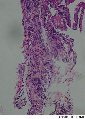 Biopsy of the jejunal ulcer seen on esophagogastroduodenoscopy.