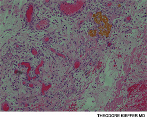 The resected jejunum with the transmural defect and serositis.