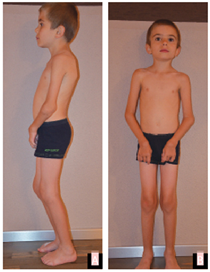 A patient with late presentation of Farber disease at age 8 years and 1 month. Lateral view (A) and anterior view (B). Note the significant contractures of both knees and elbows, as well as swelling over wrists and ankles.