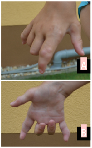 Right hand of a patient with late onset of Farber disease at age 8 years and 1 month. Dorsal view (A) and palmar view (B). Clearly visible are multiple nodules, especially over the metacarpal and proximal interphalangeal joint of the index finger, swelling of the wrist joint and flexion contractures of fingers 3 and 4.