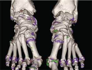 Three-dimensional volume-rendered image showing MSU crystal deposition (green) at sites throughout the feet, including the first metatarsophalangeal joints and midfeet in a patient with gout