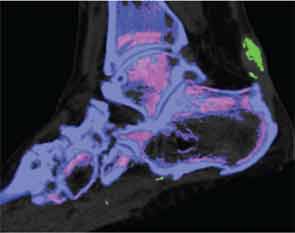 Two-dimensional sagittal image showing MSU crystal deposition (green) within the Achilles tendon.