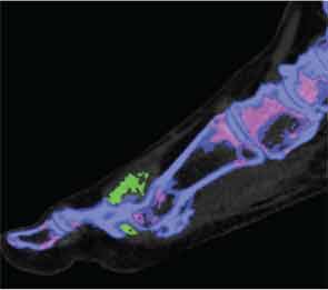 Two-dimensional sagittal image showing close relationship between MSU crystal deposition (green) and bone erosion at the 1st metatarsophalangeal joint.