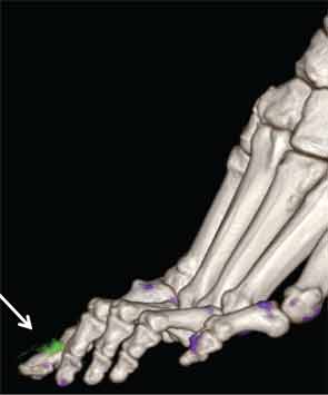 Three-dimensional volume-rendered image showing artifact at the toenails (arrow), with no other evidence of MSU crystal deposition