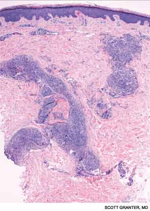 Histopathologic examination revealed nodular aggregates of histiocytes forming non-necrotizing, “naked” granulomas.