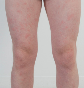 Figure 1: Case 1 with multiple urticarial lesions on both thighs prior to treatment.
