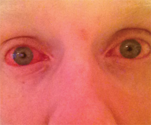 Figure 2: Case 1 showing conjunctivitis, which was recurrent.
