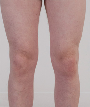 Figure 3: Case 1 two weeks after canakinumab injection showing complete absence of urticarial lesions.