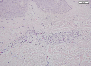 Figure 5: Skin biopsy of “urticaria” showing dermal perivascular infiltrates, consisting primarily of polymorphonuclear cells. H&E X400.