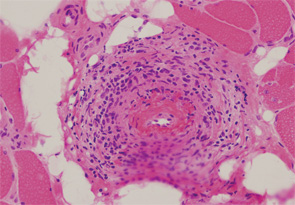 Muscle & Peripheral Nerve Disease?