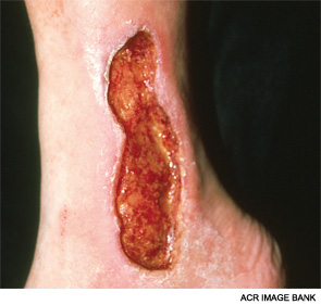 A large, well-demarcated ulcer along the medial malleolar area is shown in a patient with systemic sclerosis. Such ulcers are associated with small-vessel vasculitis.