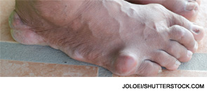 Gout management is often crisis driven.