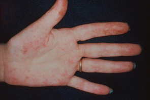 Patients with antiphospholipid syndrome often suffer from vascular lesions.