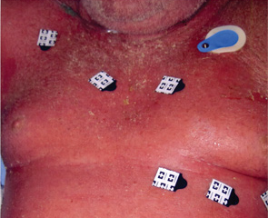Figure 1: Red rash on the patient’s torso.