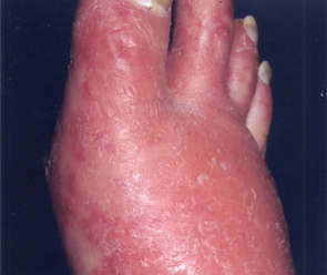 Figure 2: Scaling red rash on the patient’s foot.