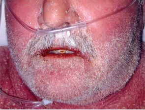 Figure 3: Anasarca of the face.