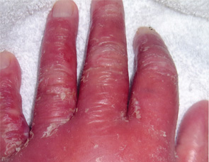 Figure 4: Severe anasarca of patient’s hand.