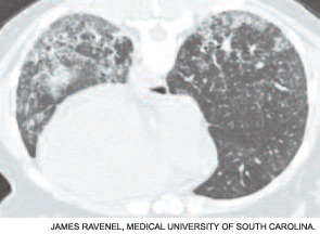 Figure 2b: Fibrosis and traction bronchiectasis .