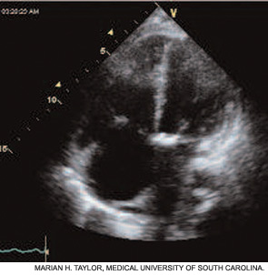 Figure 3: Echocardiogram.