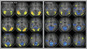 Figure 2: fMRI images for assessing the effects of childhood-onset SLE on brain activation patterns when testing attention using a continuous performance paradigm. Differences in activation (yellow) and suppression (blue) patterns in children with SLE and healthy controls. In SLE, larger brain areas need to be activated for performing an fMRI task and fewer are suppressed.