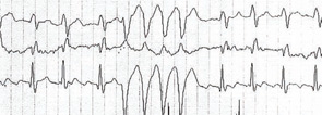 Figure 2: A Holter surface EKG with complex ventricular tachycardia before ICD implantation.