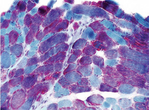 Prominent ragged red fibers detected by trichrome Gomori staining, fulfilling a major criterion of the modified Walker diagnostic criteria.