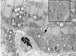 Electron micrograph demonstrating the presence of numerous mitochondrial aggregates containing variable numbers of mitochondria (arrow). Clusters of many misshapen mitochondria were common within these aggregates (inset).