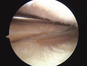 Figure 2C: Intraoperative arthroscopic photograph showing medial meniscus extrusion and medial compartment OA.