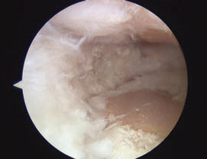 Figure 2D: Intraoperative arthroscopic photograph after medial meniscus debridement.