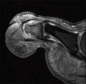 Figure 1A: T1 fat-suppressed gadolinium enhanced MRI image of the toe in a patient with psoriatic arthritis demonstrating bone marrow edema.