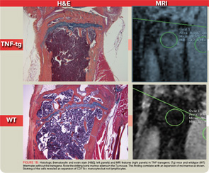 Figure 1B: Histologic (hematoxylin and eosin stain [H&E]; left panels) and MRI features (right panels) in TNF transgenic (Tg) mice and wildtype (WT) littermates without the transgene. Note the striking bone marrow edema in the Tg mouse. This finding correlates with an expansion of red marrow as shown. Staining of the cells revealed an expansion of CD11b+ monocytes but not lymphocytes.
