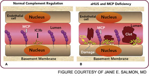 Figure 4: Atypical hemolytic uremic syndrome and deficiency of complement regulators.