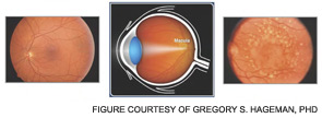 Figure 5: AMD and clinical features.