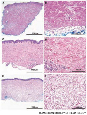 Figure 2: Serial skin biopsies from a single patient with SSc undergoing hematopoietic cell transplantation. Before transplant (A and B), dense collagen deposits are prominent. One year after treatment (C and D), the fibrosis has improved, and five years after transplant the fibrosis has resolved and the skin is normal (E and F). Low-power (5X) views are on the left (A, C, and E), and high-power (20X) micrographs are on the right (B, D, and F).